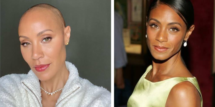 Jada Pinkett Smith Hair Loss